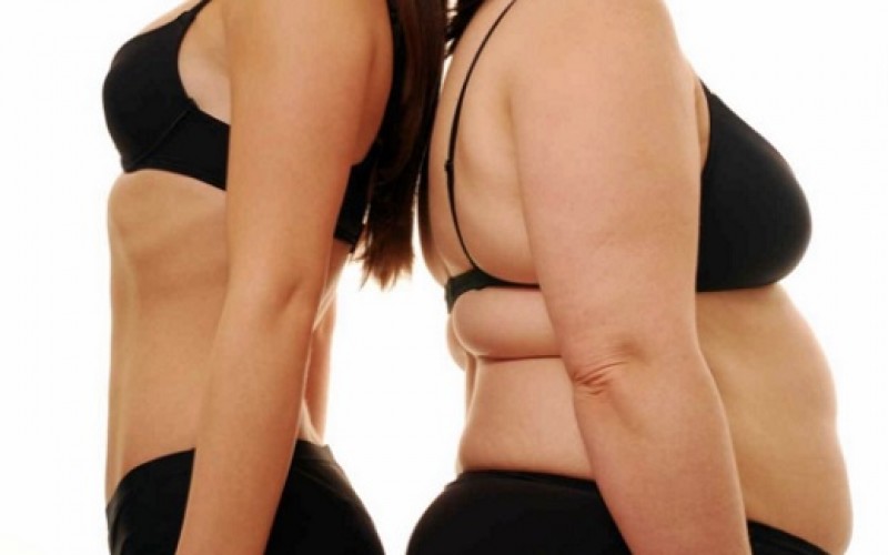 La Operación de Manga Gástrica, como una alternativa para la obesidad