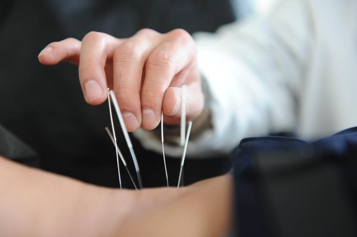 Una persona recibiendo acupuntura en el brazo.